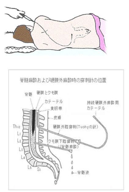 無痛分娩位置